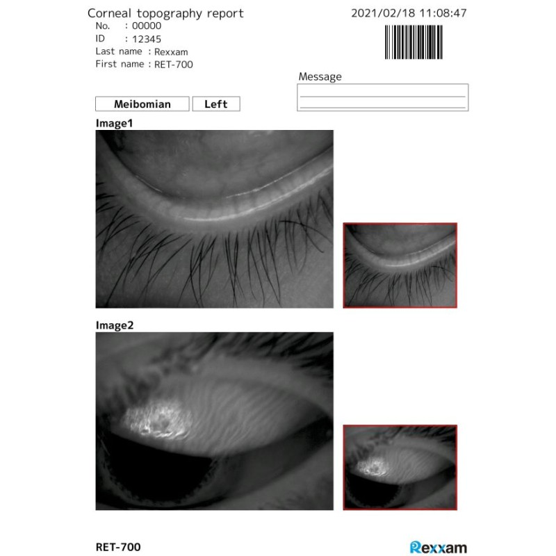 REXXAM - RET-700 Dry-Eye module with Infra-Red Meibomian analysis